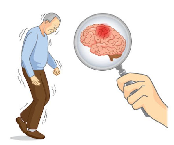 Parkinson’s Disease Care